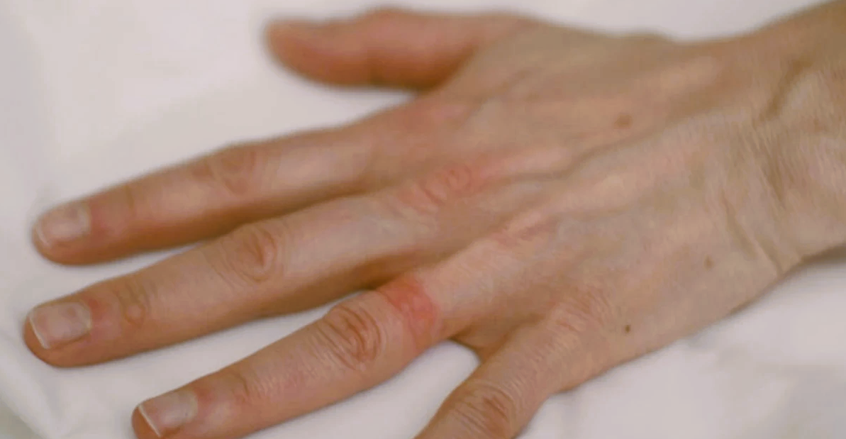 Is it possible to have an allergy to silicone rings?